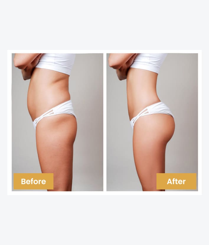 Benefits of a Mommy Makeover